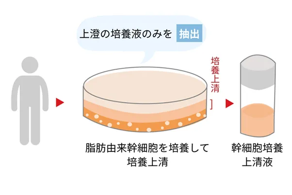 毛髪再生 浄化濃縮幹細胞培養上清液注射