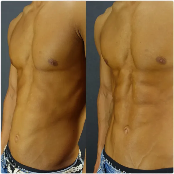 Before / After（1ヶ月後）