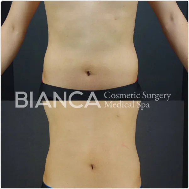 Before / After（1ヶ月後）