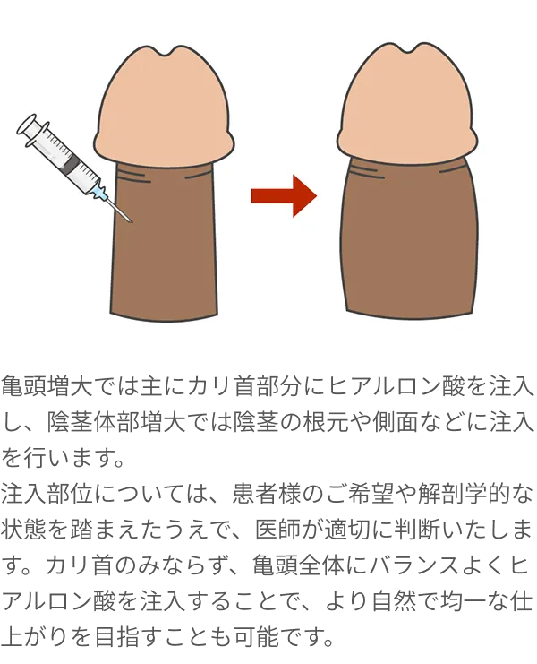 注入部位・効果イラスト