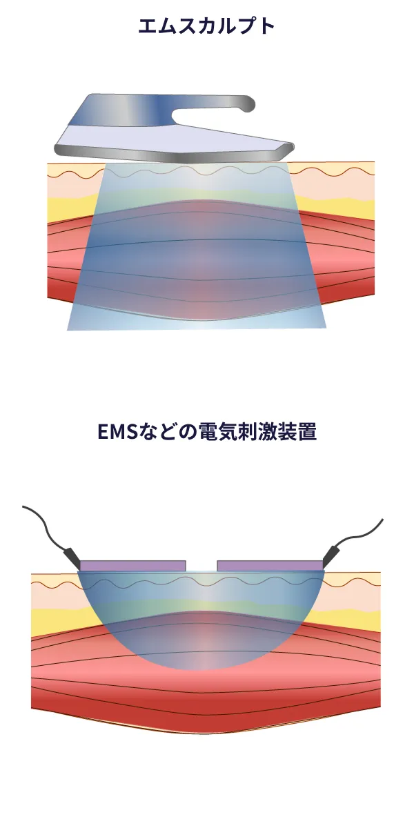 EMSなどの電気刺激装置