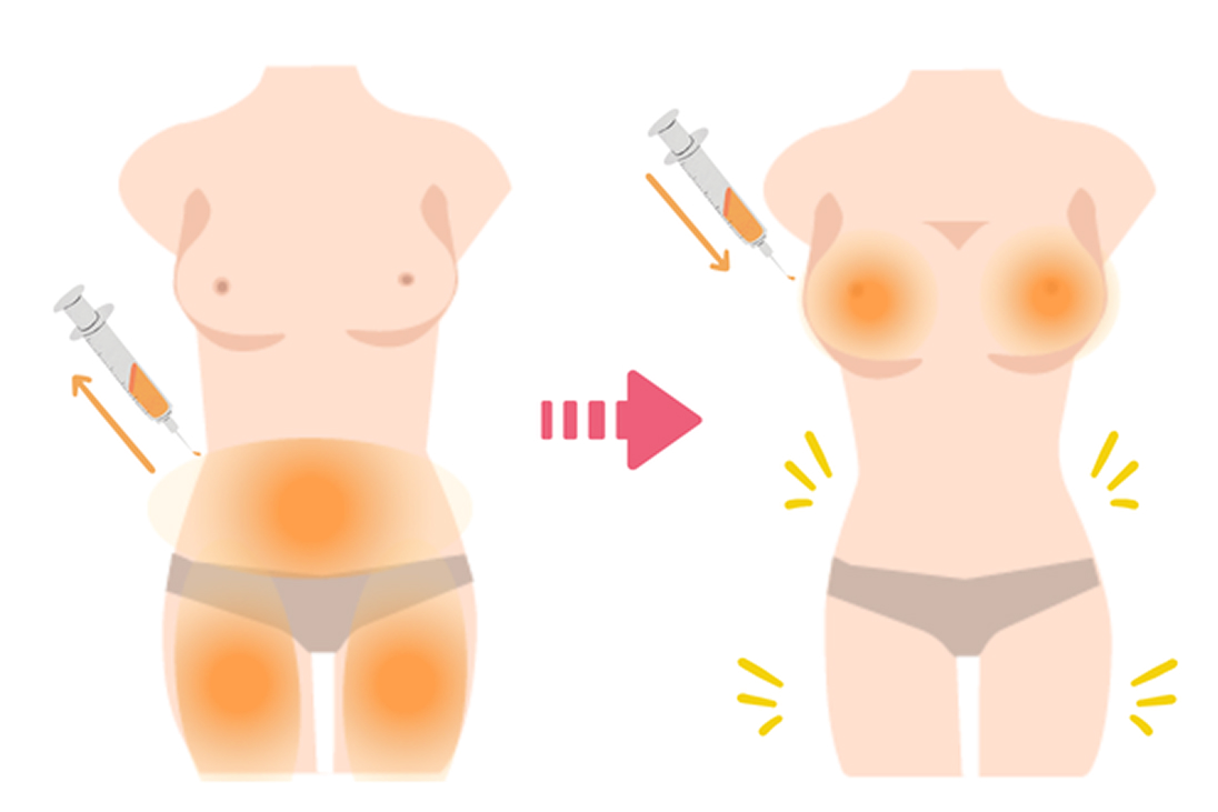 コンデンスリッチ脂肪注入豊胸