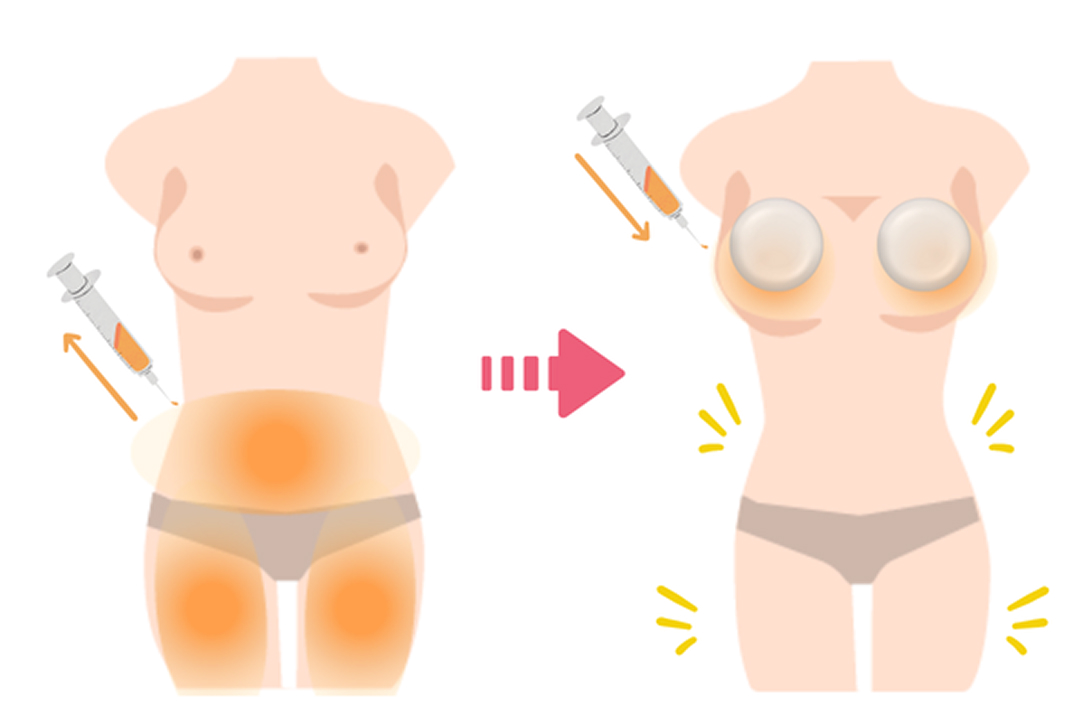 ハイブリッド豊胸(シリコンバッグ+コンデンスリッチ)