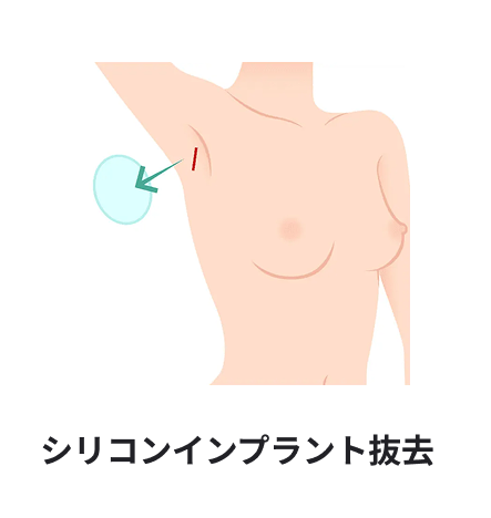 シリコンインプラント抜去