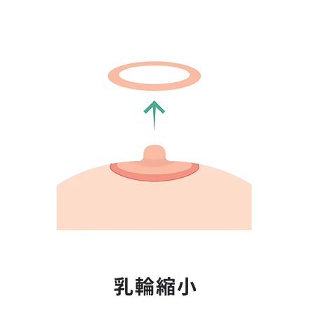 乳輪縮小